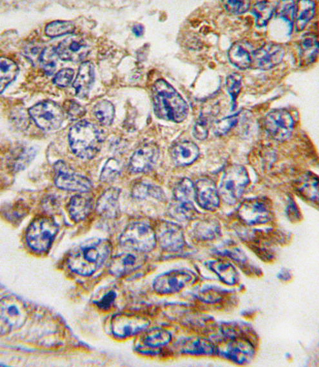 Formalin-fixed and paraffin-embedded human lung carcinoma tissue reacted with GRB2 Antibody (Y209) , which was peroxidase-conjugated to the secondary antibody, followed by DAB staining.