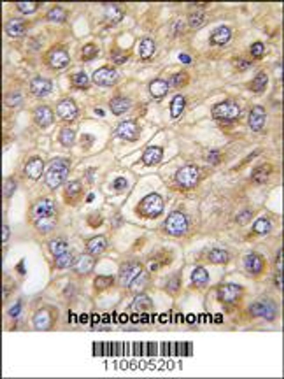 Formalin-fixed and paraffin-embedded human hepatocarcinoma tissue reacted with CLDN2 (Human N-term) , which was peroxidase-conjugated to the secondary antibody, followed by DAB staining.