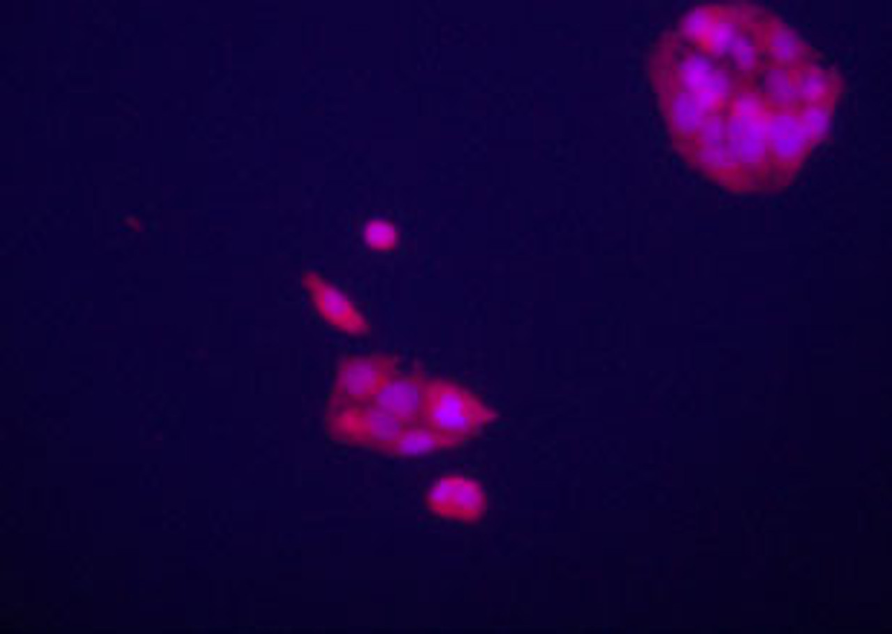 Immunofluorecence staining of anti-GPC3 Pab on HepG2 cells. The cells were acetone fixated. Antibody dilution of 1:50. Original magnification 1:400. Data and protocol courtesy of Dr. Mariana Dabeva, Department of Medicine at Albert Einstein College of Medicine.