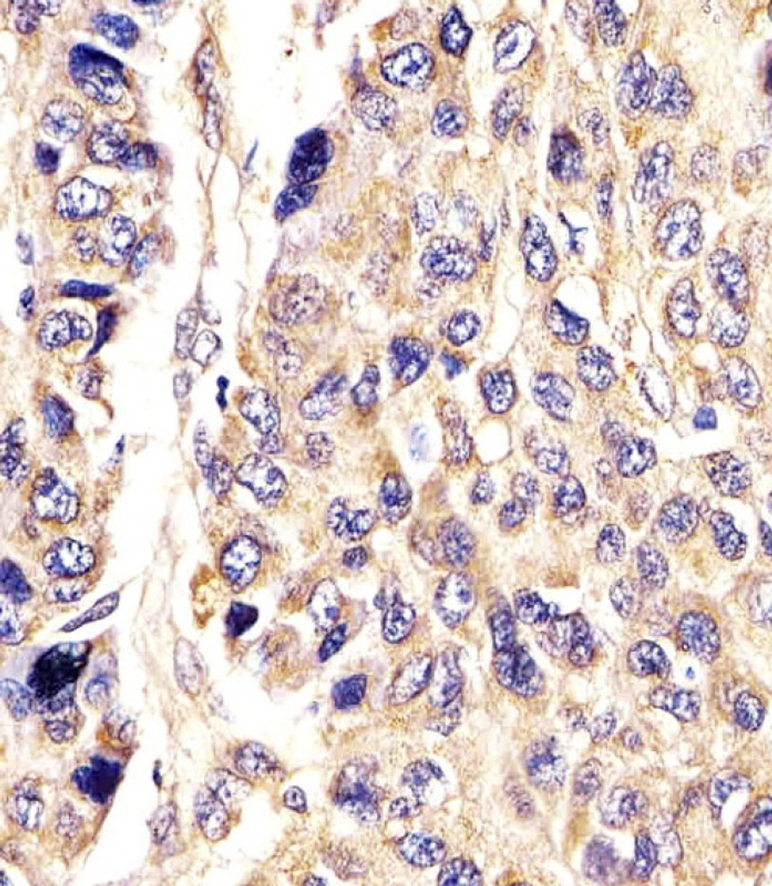 Antibody staining AGXT in Human hepatic carcinoma tissue sections by Immunohistochemistry (IHC-P - paraformaldehyde-fixed, paraffin-embedded sections) .