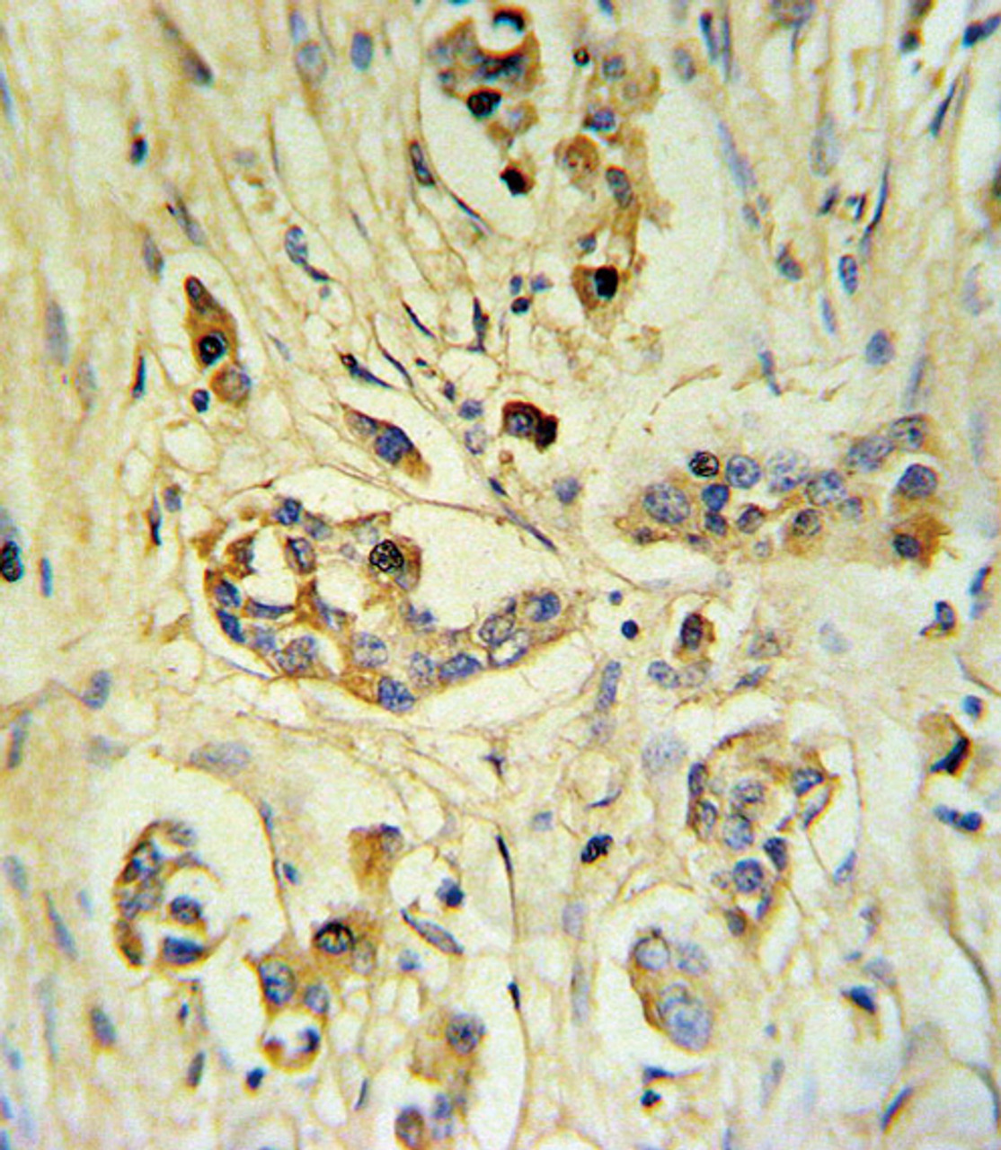 FIBB Antibody IHC analysis in formalin fixed and paraffin embedded human breast carcinoma followed by peroxidase conjugation of the secondary antibody and DAB staining.