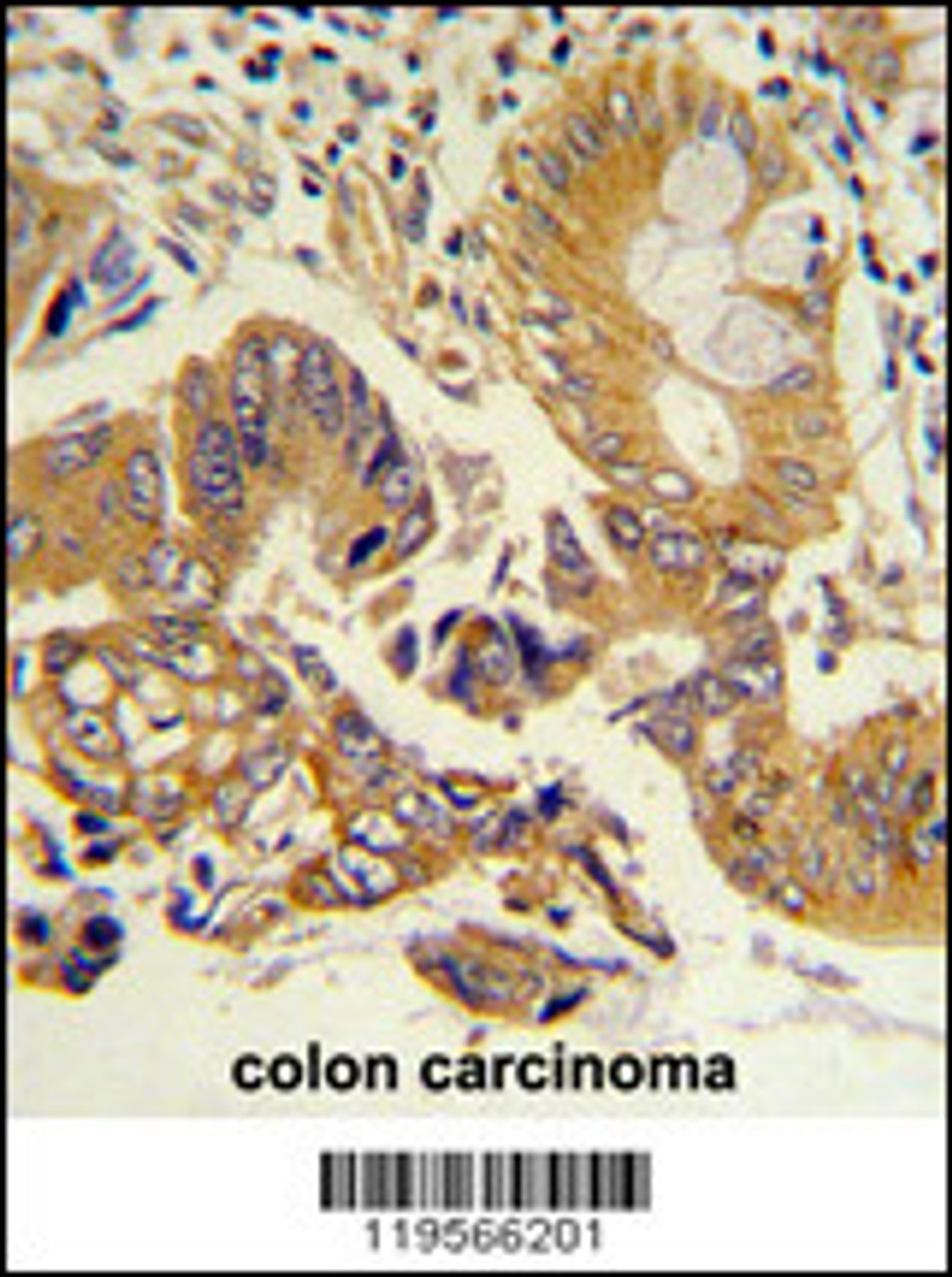 Formalin-fixed and paraffin-embedded human colon carcinoma reacted with CLNS1A Antibody, which was peroxidase-conjugated to the secondary antibody, followed by DAB staining.