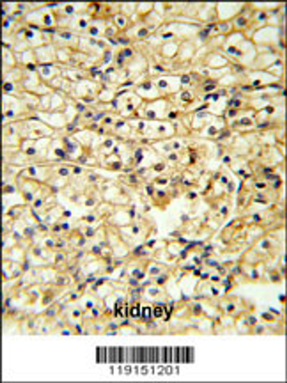 TRAP Antibody IHC analysis in formalin fixed and paraffin embedded kidney carcinoma followed by peroxidase conjugation of the secondary antibody and DAB staining.