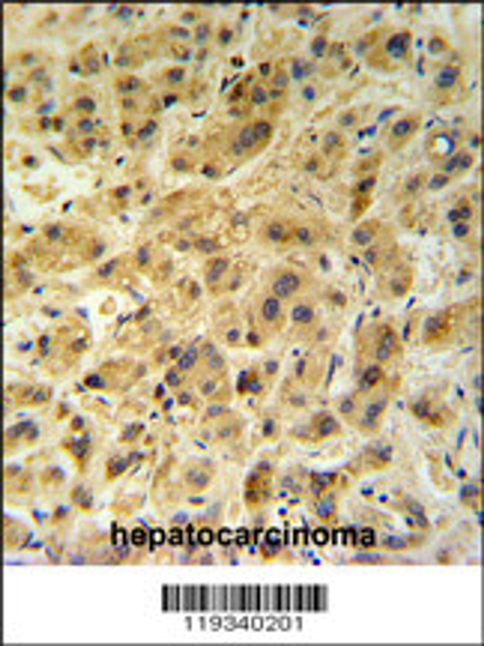 GNS Antibody (Center N189) IHC analysis in formalin fixed and paraffin embedded human hepatocarcinoma followed by peroxidase conjugation of the secondary antibody and DAB staining.