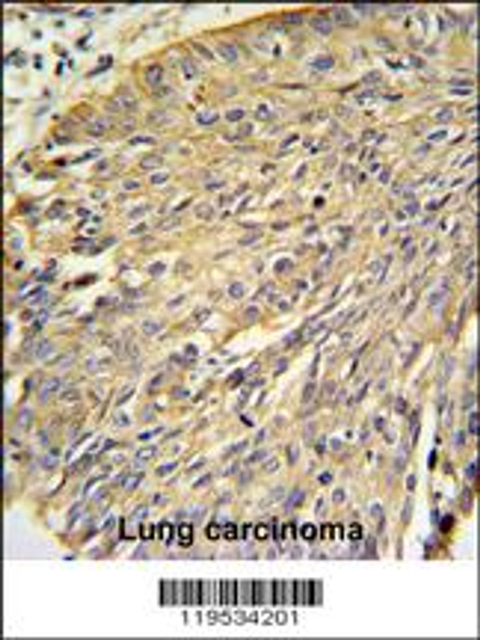 Annexin A1 Antibody IHC analysis in formalin fixed and paraffin embedded human lung carcinoma followed by peroxidase conjugation of the secondary antibody and DAB staining.