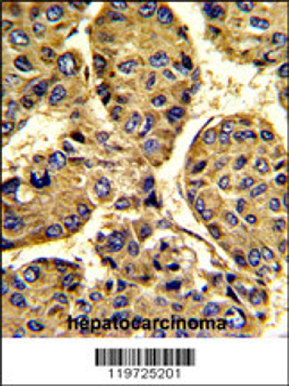 Formalin-fixed and paraffin-embedded human hepatocarcinoma with ASPN Antibody, which was peroxidase-conjugated to the secondary antibody, followed by DAB staining.