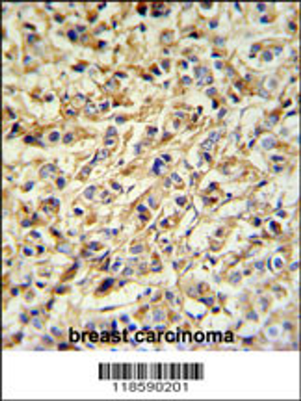 PRELP Antibody IHC analysis in formalin fixed and paraffin embedded breast carcinoma followed by peroxidase conjugation of the secondary antibody and DAB staining.