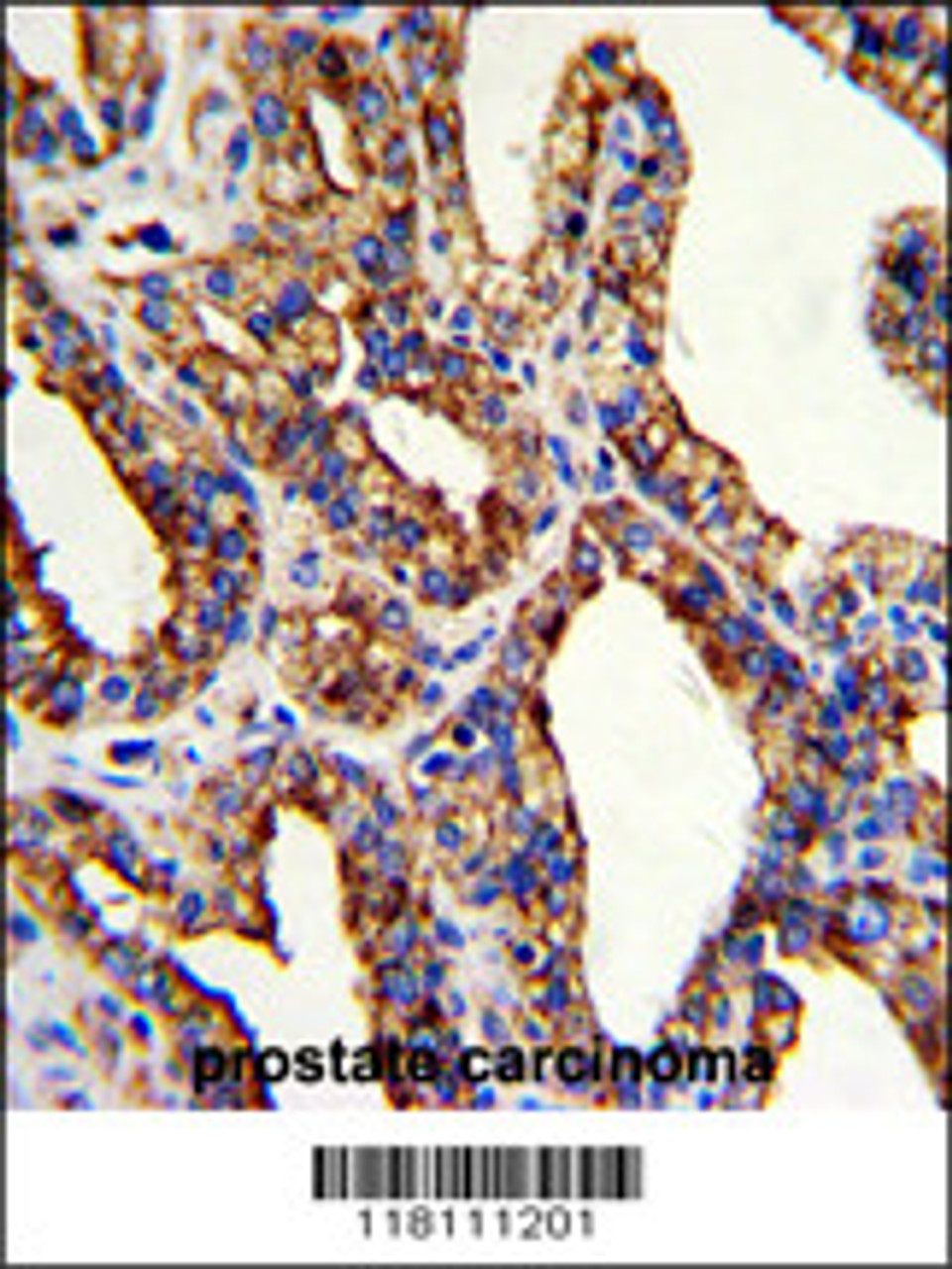 Formalin-fixed and paraffin-embedded human prostate carcinoma with TROP2 Antibody, which was peroxidase-conjugated to the secondary antibody, followed by DAB staining.