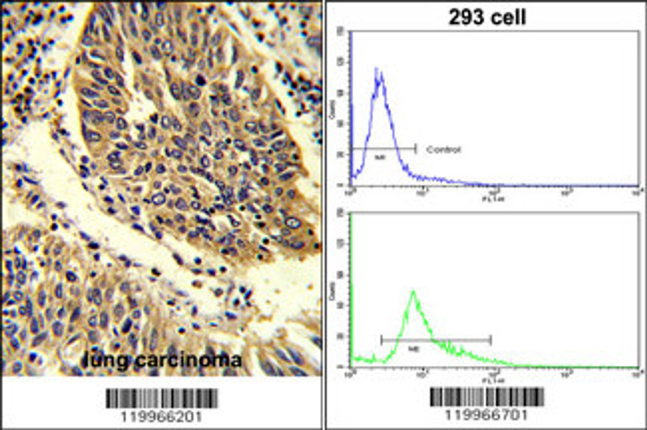 (LEFT) Formalin-fixed and paraffin-embedded human lung carcinoma reacted with WNT4 Antibody, which was peroxidase-conjugated to the secondary antibody, followed by DAB staining. (RIGHT) Flow cytometric analysis of 293 cells using WNT4 Antibody (bottom histogram) compared to a negative control cell (top histogram) . FITC-conjugated goat-anti-rabbit secondary antibodies were used for the analysis.