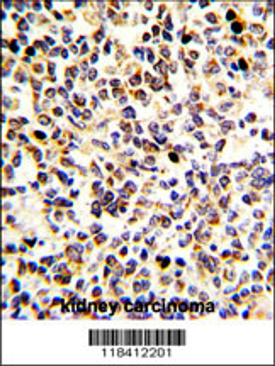 Formalin-fixed and paraffin-embedded human kidney carcinoma with KRT10 Antibody (N-term) , which was peroxidase-conjugated to the secondary antibody, followed by DAB staining.