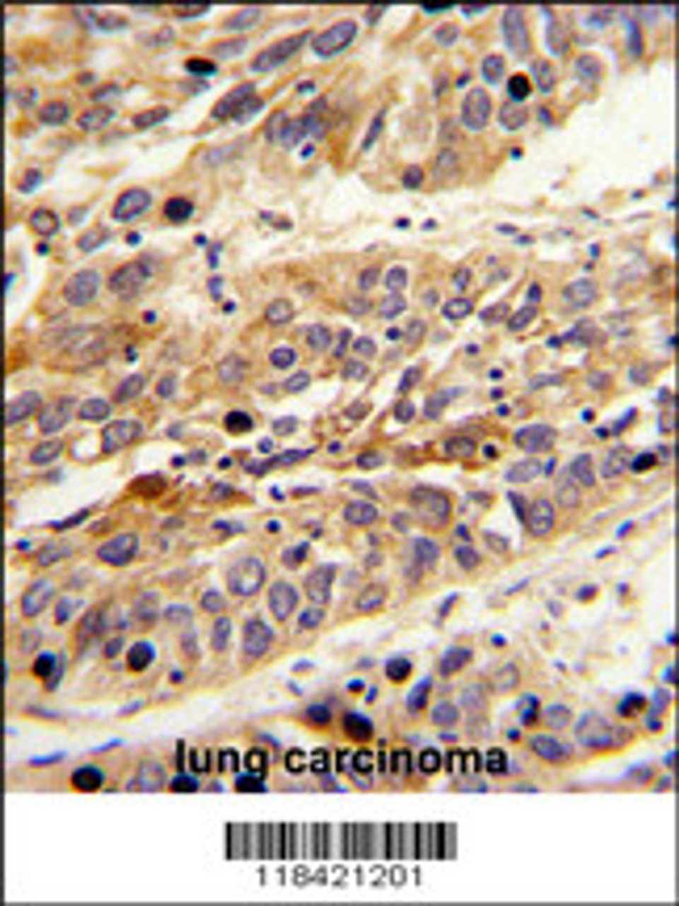 Formalin-fixed and paraffin-embedded human lung carcinoma reacted with LRG1 Antibody, which was peroxidase-conjugated to the secondary antibody, followed by DAB staining.
