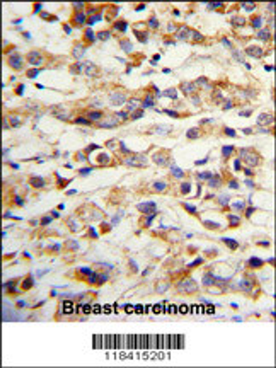 Formalin-fixed and paraffin-embedded human breast carcinoma with KRT14 Antibody, which was peroxidase-conjugated to the secondary antibody, followed by DAB staining.