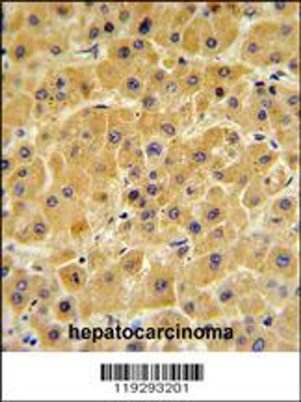 F10 Antibody IHC analysis in formalin fixed and paraffin embedded human hepatocarcinoma followed by peroxidase conjugation of the secondary antibody and DAB staining.