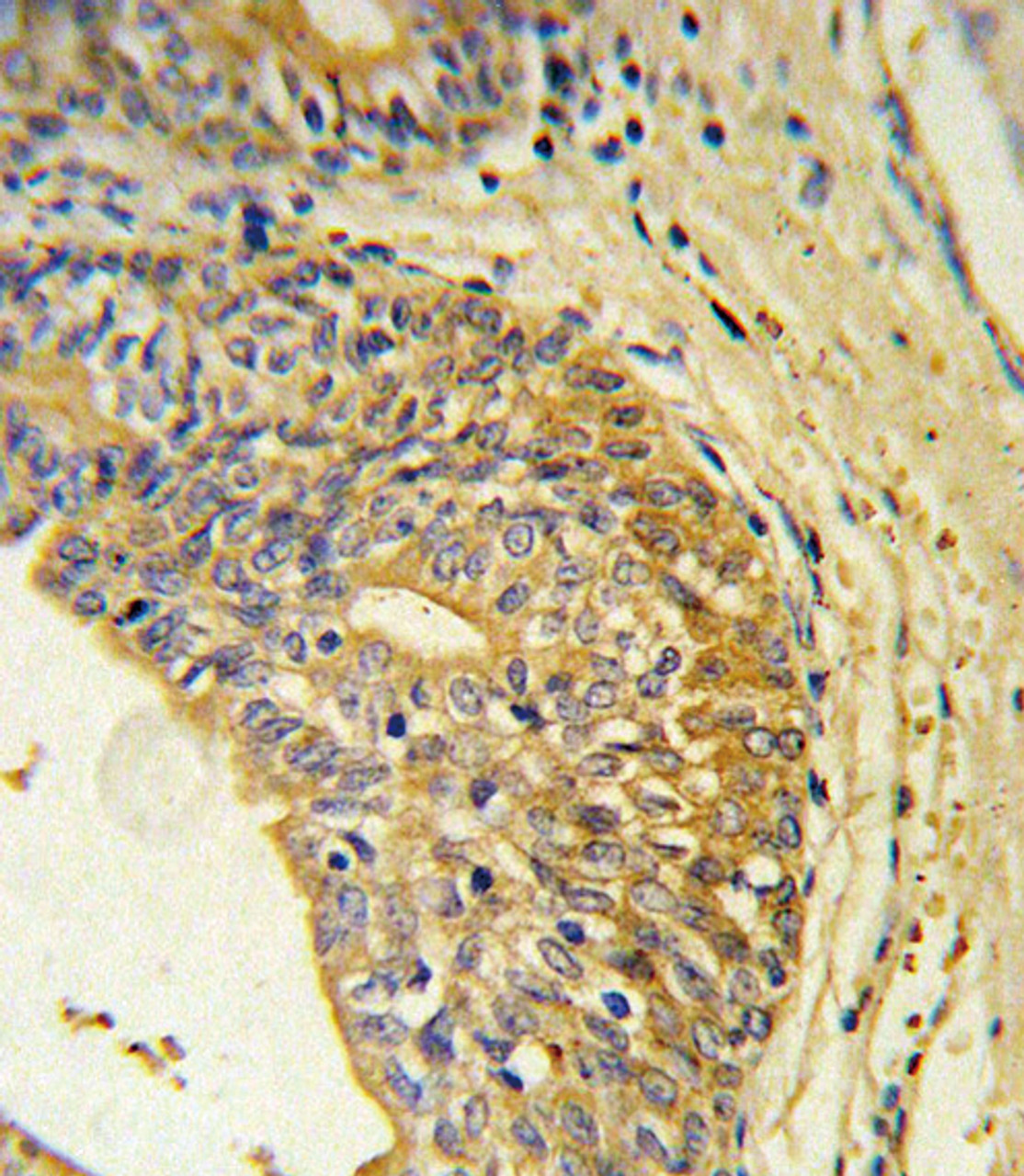 EDNRB Antibody immunohistochemistry analysis in formalin fixed and paraffin embedded human prostate carcinoma followed by peroxidase conjugation of the secondary antibody and DAB staining.