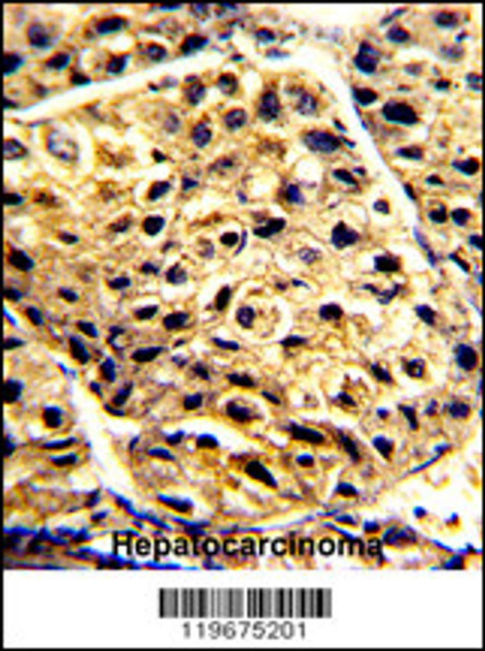Formalin-fixed and paraffin-embedded human hepatocarcinoma with AADAC Antibody, which was peroxidase-conjugated to the secondary antibody, followed by DAB staining.