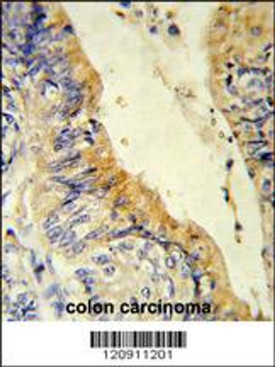 Formalin-fixed and paraffin-embedded human colon carcinoma reacted with ACADM Antibody, which was peroxidase-conjugated to the secondary antibody, followed by DAB staining.