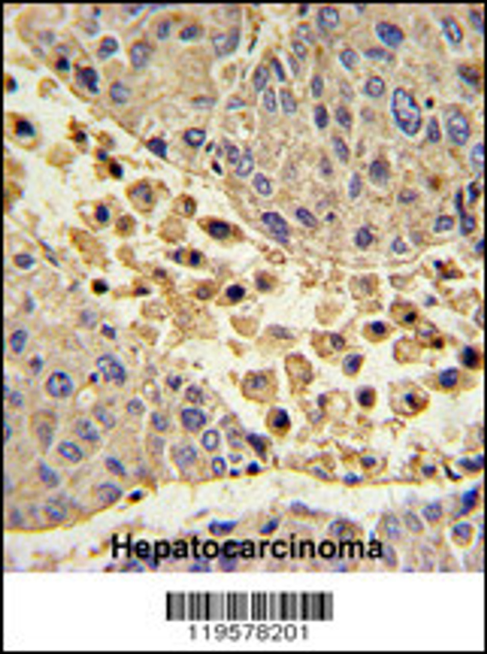 Formalin-fixed and paraffin-embedded human hepatocarcinoma with COLEC11 Antibody (N-term) , which was peroxidase-conjugated to the secondary antibody, followed by DAB staining.