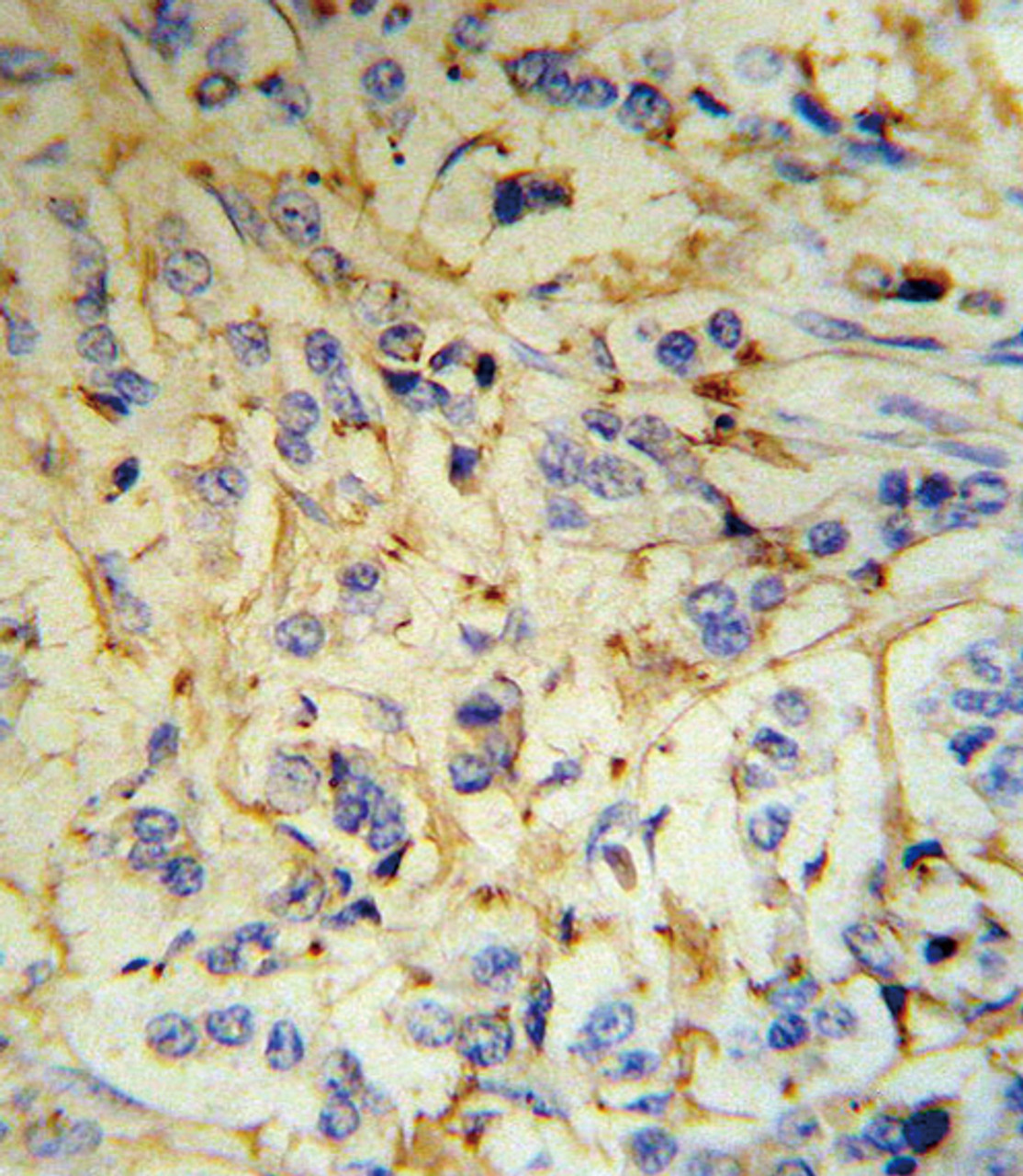 FGA Antibody (RB18707) IHC analysis in formalin fixed and paraffin embedded human breast carcinoma tissue followed by peroxidase conjugation of the secondary antibody and DAB staining.