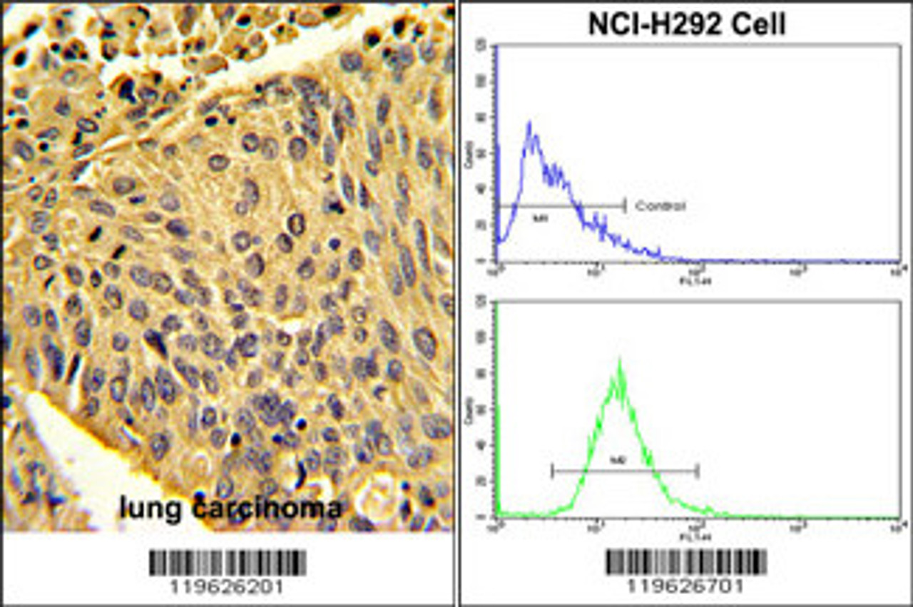 (LEFT) Formalin-fixed and paraffin-embedded human lung carcinoma with EPB41L4B Antibody, which was peroxidase-conjugated to the secondary antibody, followed by DAB staining. (RIGHT) Flow cytometric analysis of NCI-H292 cells using EPB41L4B Antibody (bottom histogram) compared to a negative control cell (top histogram) . FITC-conjugated goat-anti-rabbit secondary antibodies were used for the analysis.