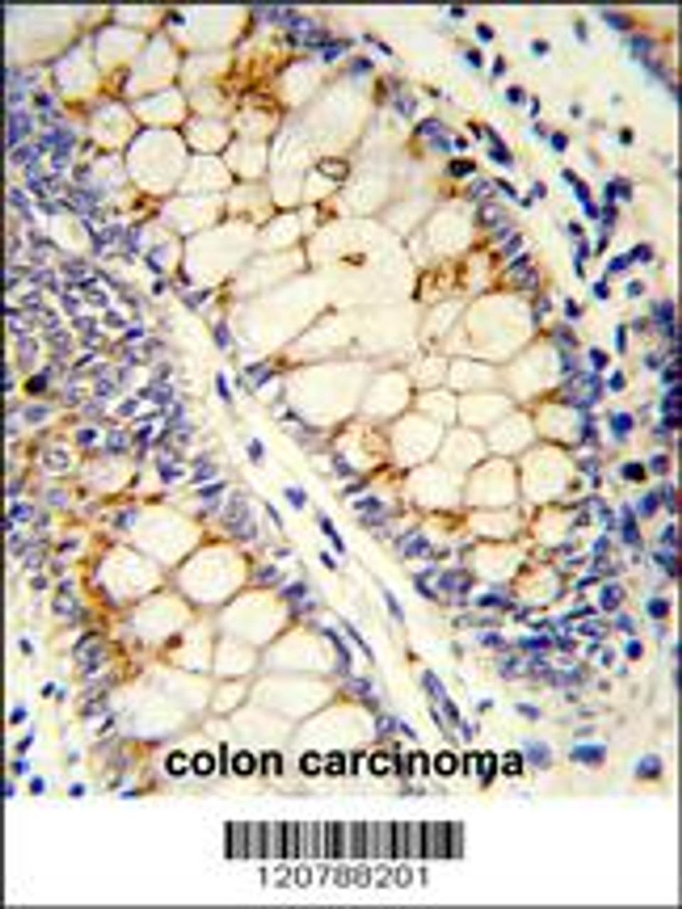 Formalin-fixed and paraffin-embedded human colon carcinoma reacted with SFRS1 Antibody, which was peroxidase-conjugated to the secondary antibody, followed by DAB staining.