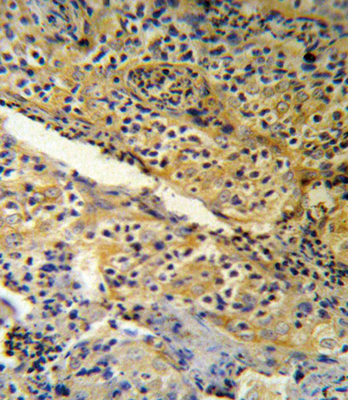 SPINK5 Antibody (RB18954) IHC analysis in formalin fixed and paraffin embedded human tonsil tissue followed by peroxidase conjugation of the secondary antibody and DAB staining.