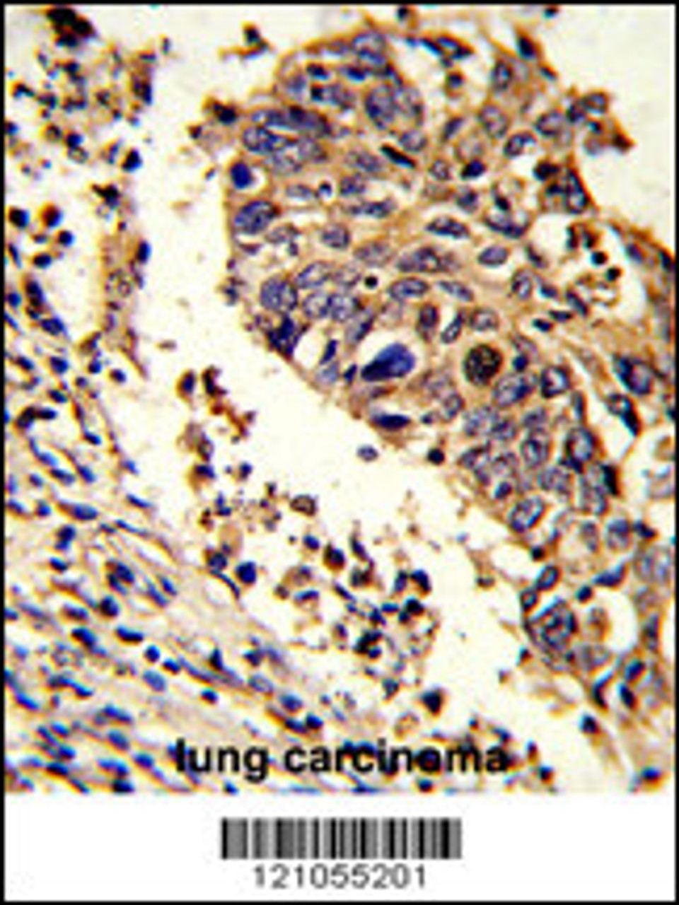 Formalin-fixed and paraffin-embedded human lung carcinoma reacted with LUC7L Antibody, which was peroxidase-conjugated to the secondary antibody, followed by DAB staining.