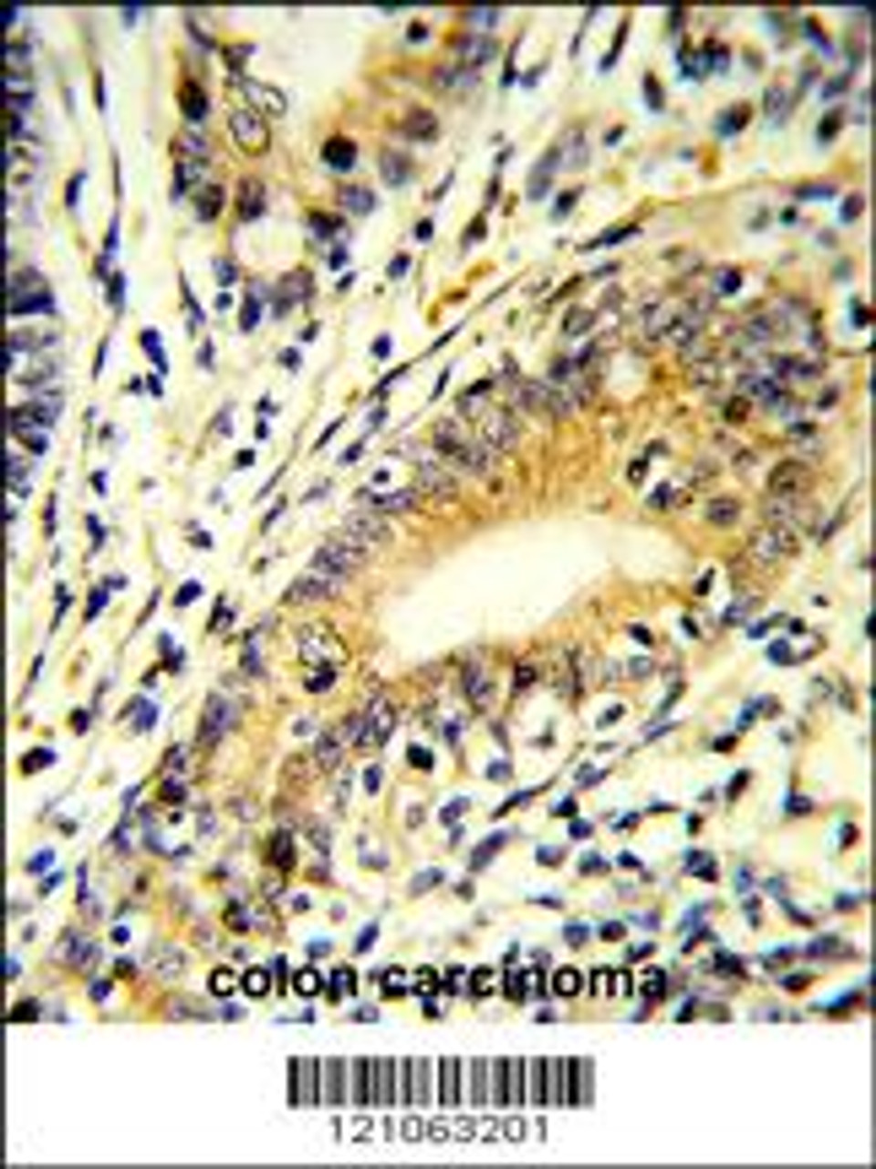 Formalin-fixed and paraffin-embedded human colon carcinoma reacted with FAM3B Antibody (N-term) , which was peroxidase-conjugated to the secondary antibody, followed by DAB staining.