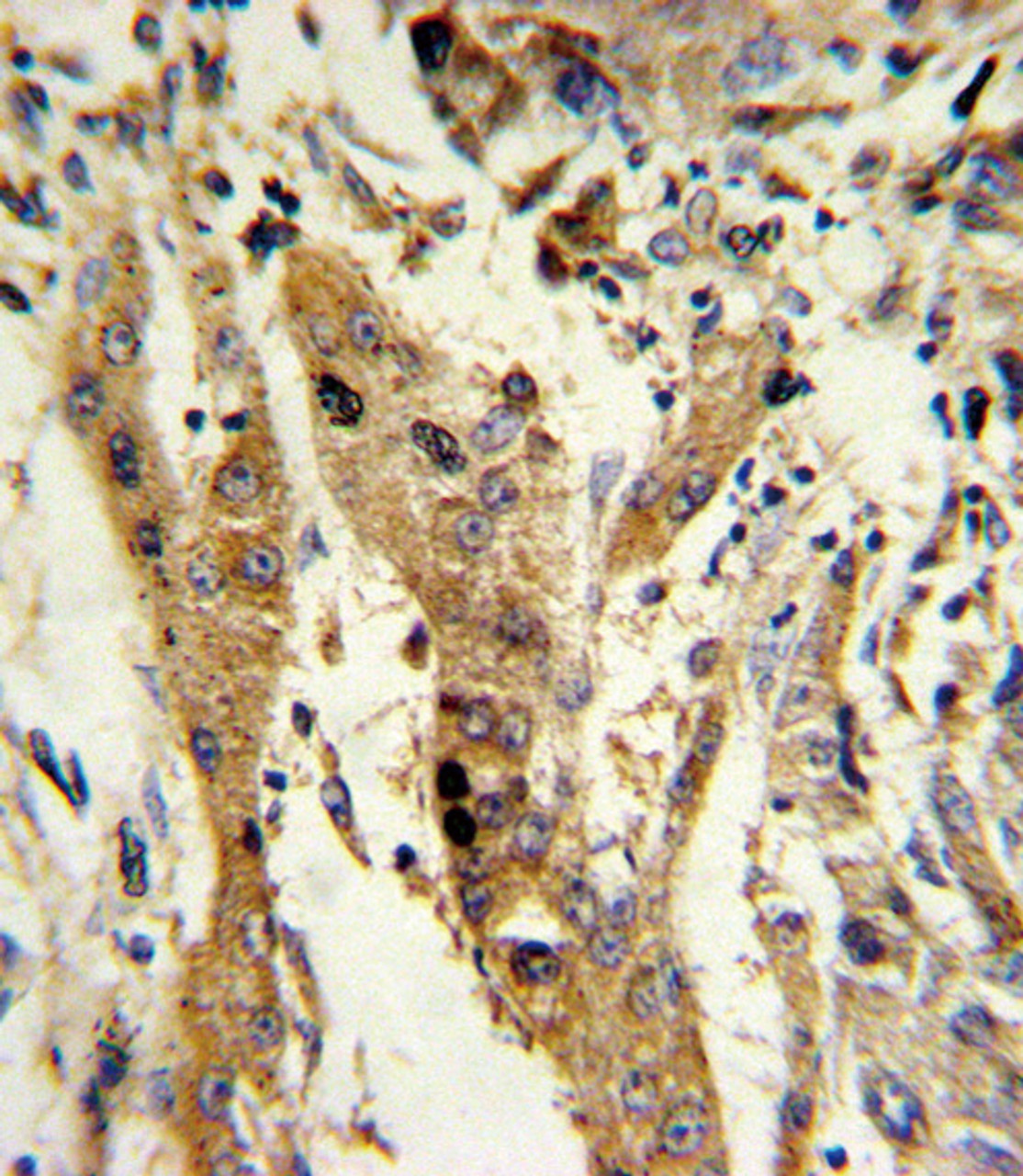 Formalin-fixed and paraffin-embedded human hepatocarcinoma reacted with GSTM1 Antibody, which was peroxidase-conjugated to the secondary antibody, followed by DAB staining.