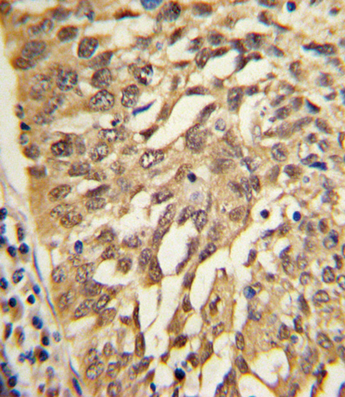 Formalin-fixed and paraffin-embedded human lung carcinoma with SAR1A Antibody, which was peroxidase-conjugated to the secondary antibody, followed by DAB staining.