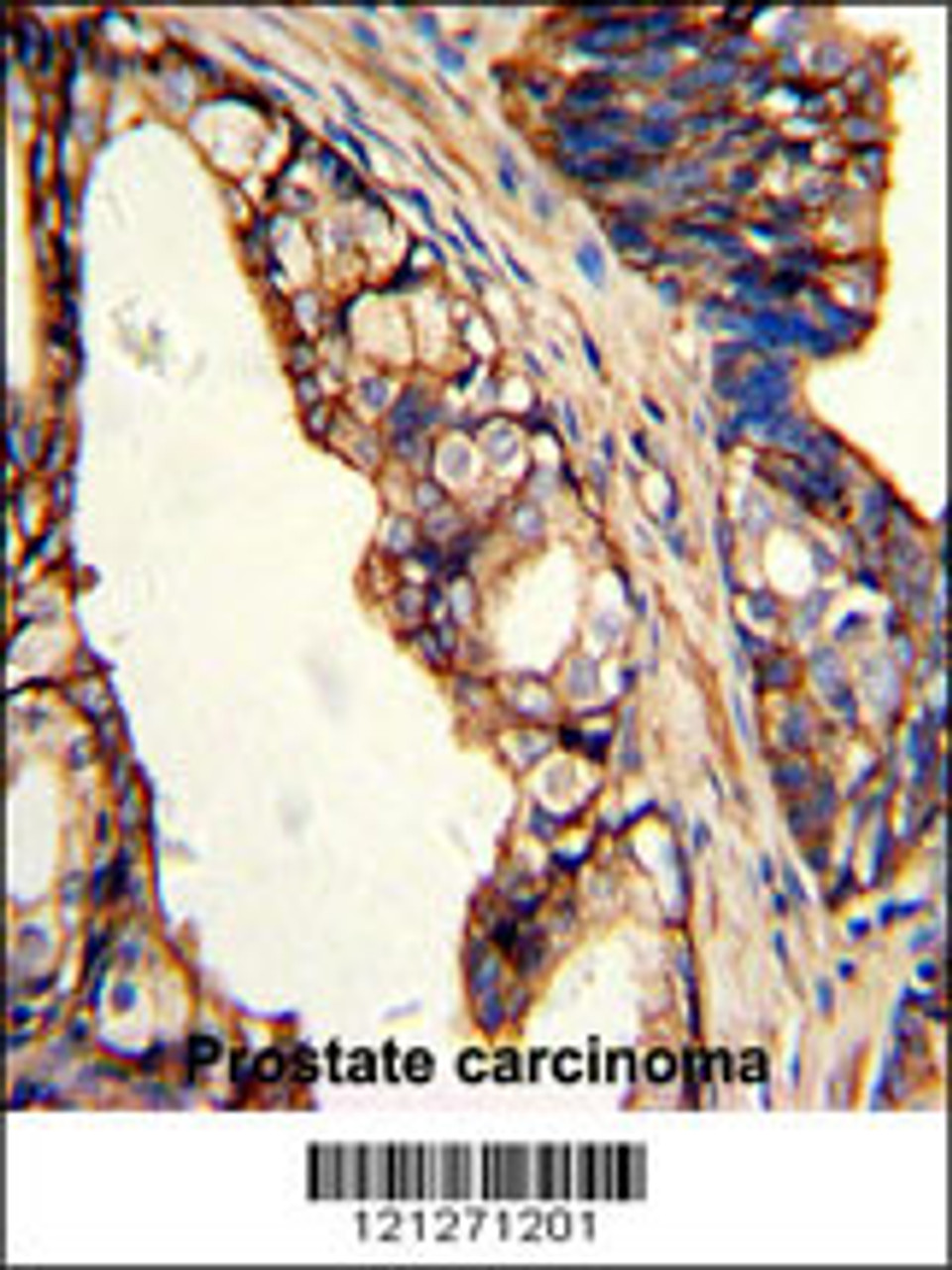 Formalin-fixed and paraffin-embedded human prostate carcinoma with TGM4 Antibody, which was peroxidase-conjugated to the secondary antibody, followed by DAB staining.