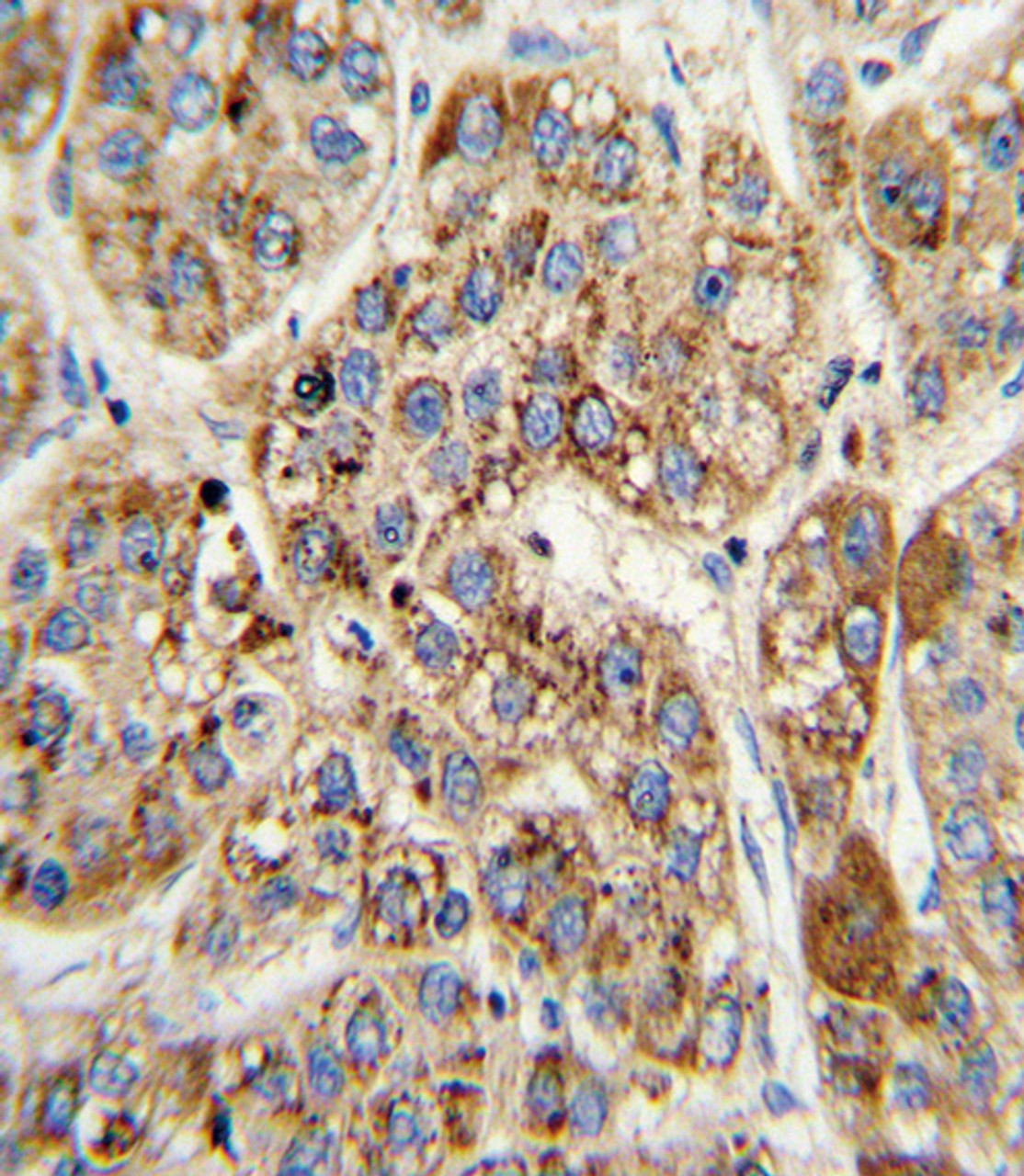 Formalin-fixed and paraffin-embedded human hepatocarcinoma with MCCC2 Antibody, which was peroxidase-conjugated to the secondary antibody, followed by DAB staining.