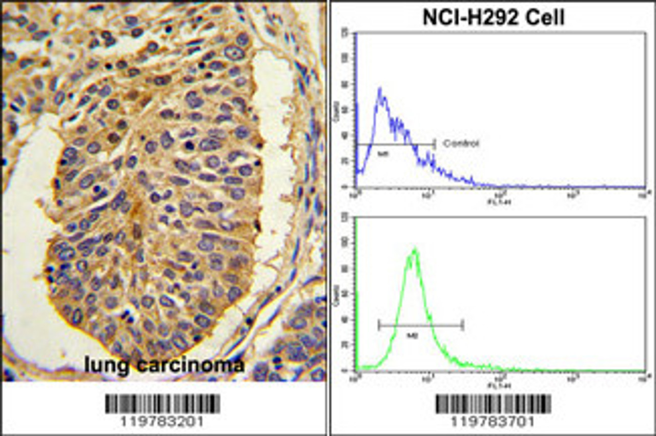 (LEFT) Formalin-fixed and paraffin-embedded human lung carcinoma with CER1 Antibody (N-term) , which was peroxidase-conjugated to the secondary antibody, followed by DAB staining. (RIGHT) Flow cytometric analysis of NCI-H292 cells using 0.025mg/ml of CER1 Antibody (bottom histogram) compared to a negative control cell (top histogram) . FITC-conjugated goat-anti-rabbit secondary antibodies were used for the analysis.