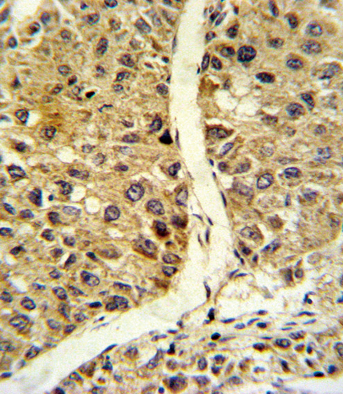 Formalin-fixed and paraffin-embedded human hepatocarcinoma reacted with NOS3 Antibody (N-term) , which was peroxidase-conjugated to the secondary antibody, followed by DAB staining.