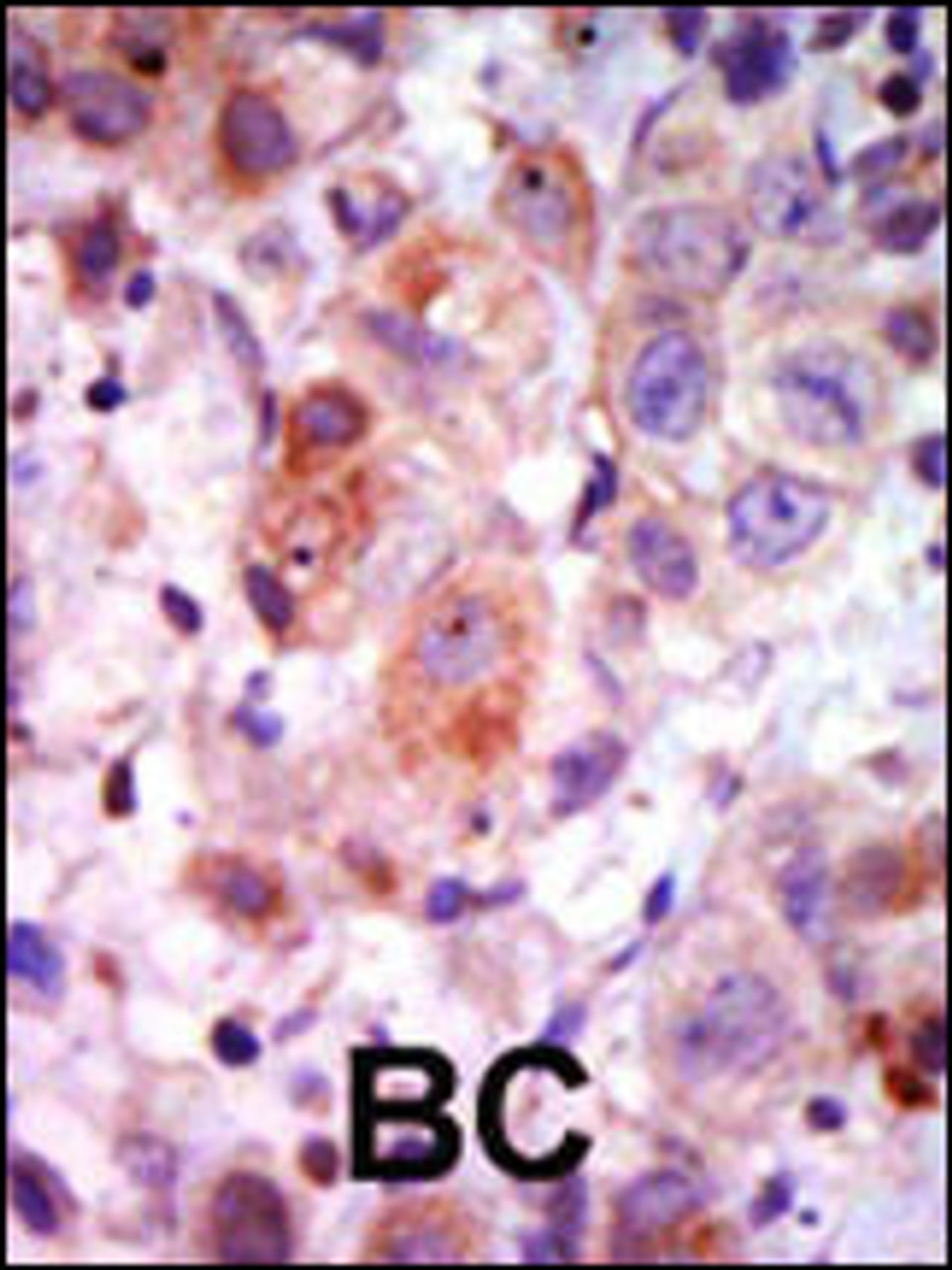 Formalin-fixed and paraffin-embedded human cancer tissue reacted with the primary antibody, which was peroxidase-conjugated to the secondary antibody, followed by AEC staining. BC = breast carcinoma; HC = hepatocarcinoma.