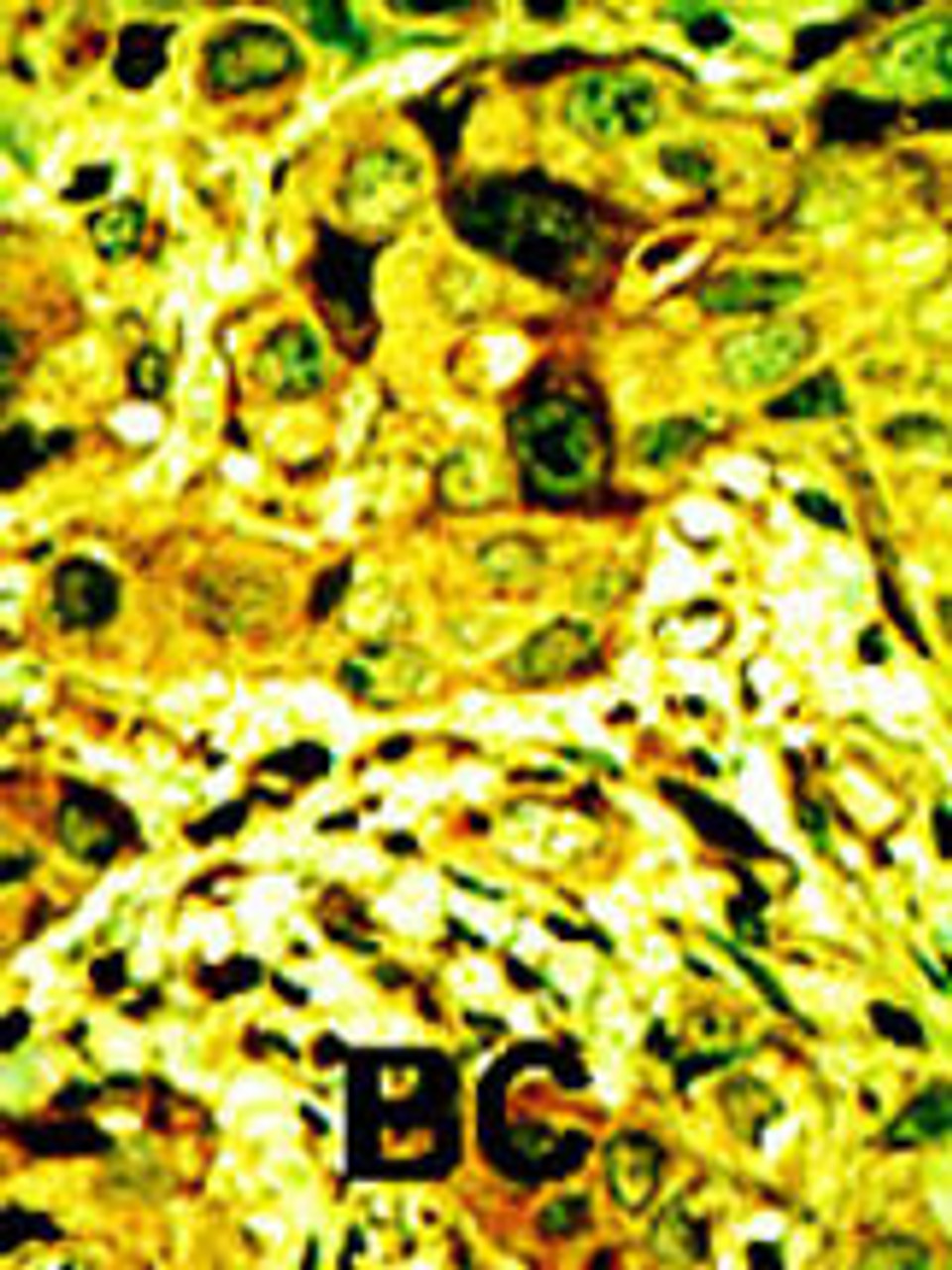 Formalin-fixed and paraffin-embedded human cancer tissue reacted with the primary antibody, which was peroxidase-conjugated to the secondary antibody, followed by AEC staining. BC = breast carcinoma; HC = hepatocarcinoma.