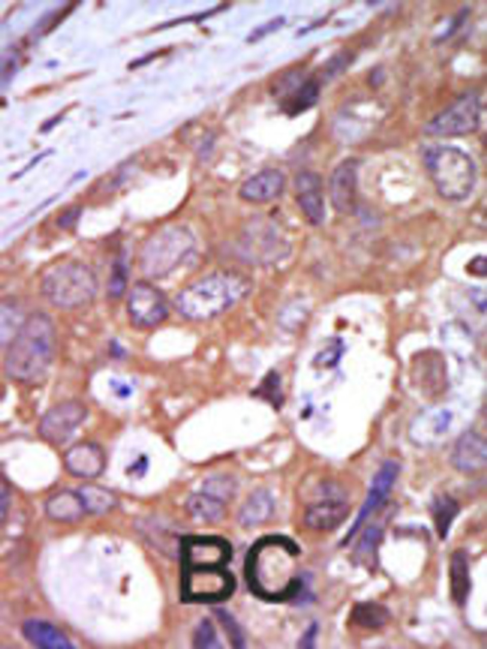 Formalin-fixed and paraffin-embedded human cancer tissue reacted with the primary antibody, which was peroxidase-conjugated to the secondary antibody, followed by AEC staining. BC = breast carcinoma; HC = hepatocarcinoma.