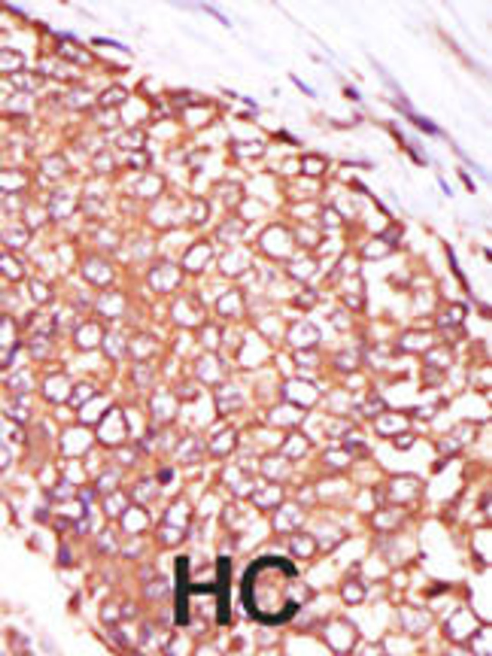 Formalin-fixed and paraffin-embedded human cancer tissue reacted with the primary antibody, which was peroxidase-conjugated to the secondary antibody, followed by DAB staining. BC = breast carcinoma; HC = hepatocarcinoma.