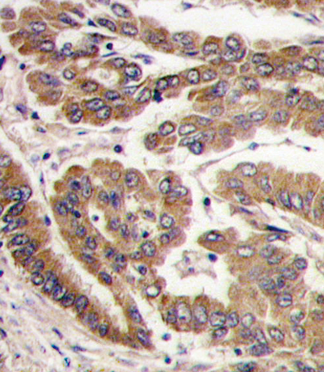 Formalin-fixed and paraffin-embedded human lung carcinoma tissue reacted with PKC zeta antibody (N-term) , which was peroxidase-conjugated to the secondary antibody, followed by DAB staining.