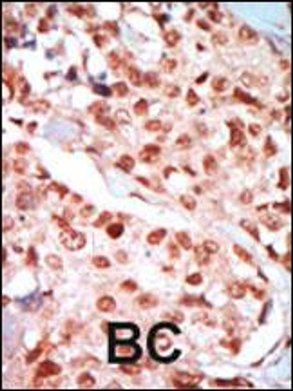 Formalin-fixed and paraffin-embedded human cancer tissue reacted with the primary antibody, which was peroxidase-conjugated to the secondary antibody, followed by DAB staining. BC = breast carcinoma; HC = hepatocarcinoma.