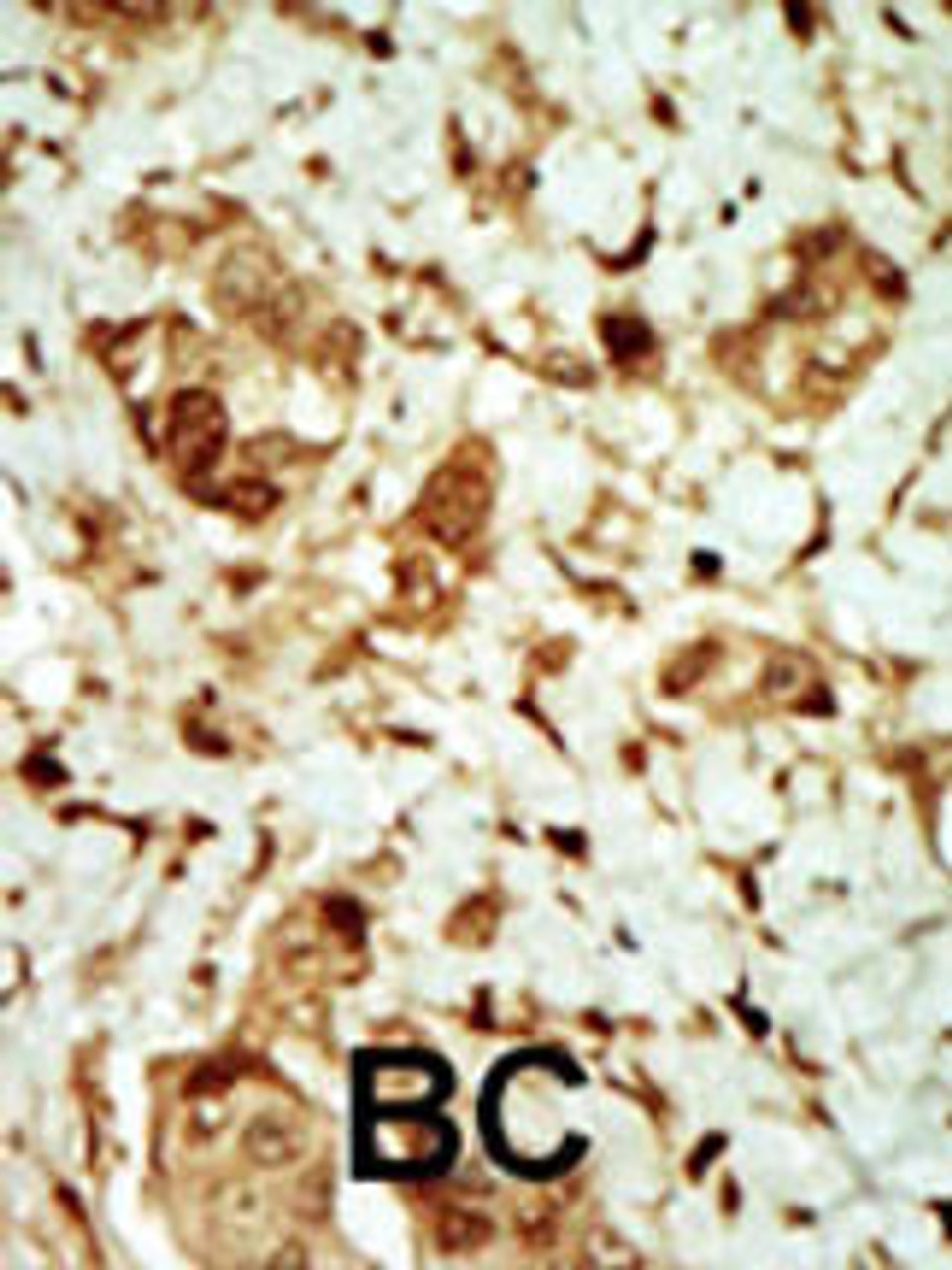 Formalin-fixed and paraffin-embedded human cancer tissue reacted with the primary antibody, which was peroxidase-conjugated to the secondary antibody, followed by DAB staining. BC = breast carcinoma; HC = hepatocarcinoma.