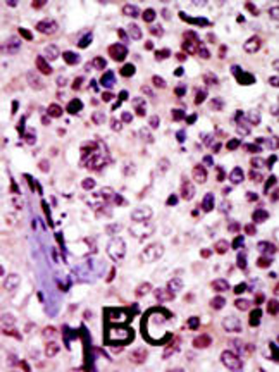 Formalin-fixed and paraffin-embedded human cancer tissue reacted with the primary antibody, which was peroxidase-conjugated to the secondary antibody, followed by AEC staining. BC = breast carcinoma; HC = hepatocarcinoma.