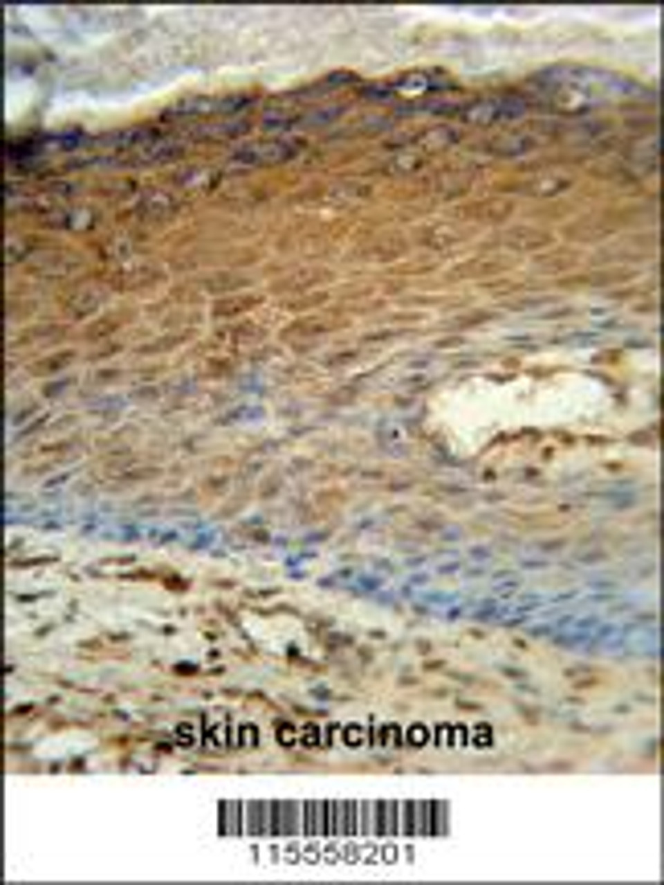 AK7 Antibody immunohistochemistry analysis in formalin fixed and paraffin embedded human skin carcinoma followed by peroxidase conjugation of the secondary antibody and DAB staining.