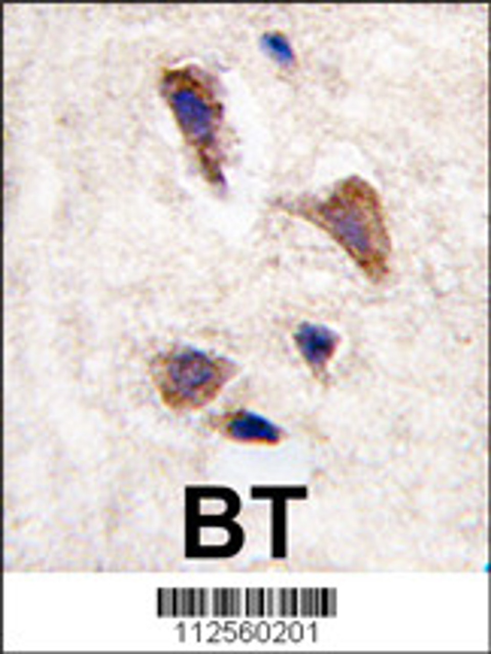 Formalin-fixed and paraffin-embedded human brain tissue reacted with CAMKK2 antibody (Cat.#AP711b) , which was peroxidase-conjugated to the secondary antibody, followed by DAB staining.