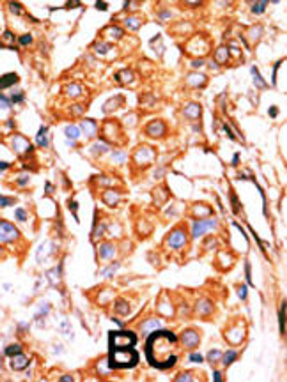 Formalin-fixed and paraffin-embedded human cancer tissue reacted with the primary antibody, which was peroxidase-conjugated to the secondary antibody, followed by AEC staining. BC = breast carcinoma; HC = hepatocarcinoma.