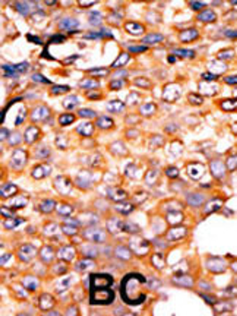 Formalin-fixed and paraffin-embedded human cancer tissue reacted with the primary antibody, which was peroxidase-conjugated to the secondary antibody, followed by AEC staining. BC = breast carcinoma; HC = hepatocarcinoma.