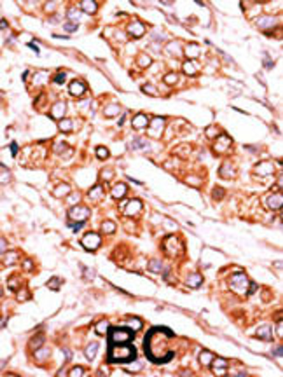 Formalin-fixed and paraffin-embedded human cancer tissue reacted with the primary antibody, which was peroxidase-conjugated to the secondary antibody, followed by DAB staining. BC = breast carcinoma; HC = hepatocarcinoma.