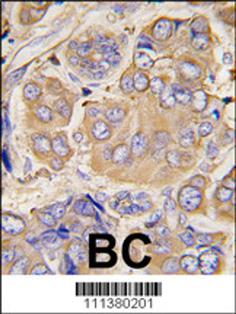 Formalin-fixed and paraffin-embedded human breast carcinoma tissue reacted with HSPB1 Antibody (S78) , which was peroxidase-conjugated to the secondary antibody, followed by DAB staining.