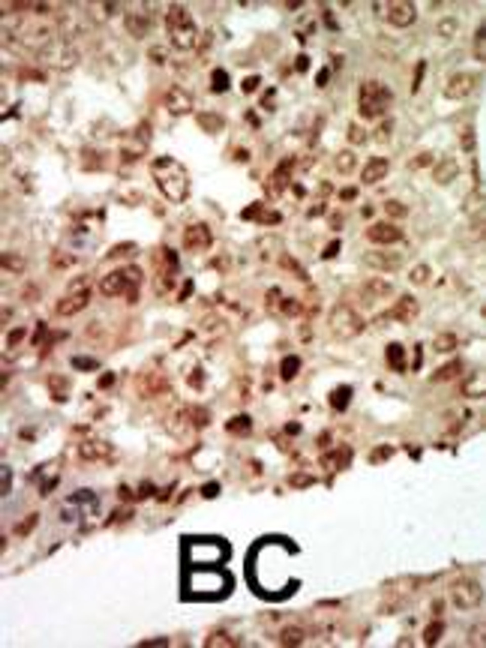 Formalin-fixed and paraffin-embedded human cancer tissue reacted with the primary antibody, which was peroxidase-conjugated to the secondary antibody, followed by AEC staining. BC = breast carcinoma; HC = hepatocarcinoma.