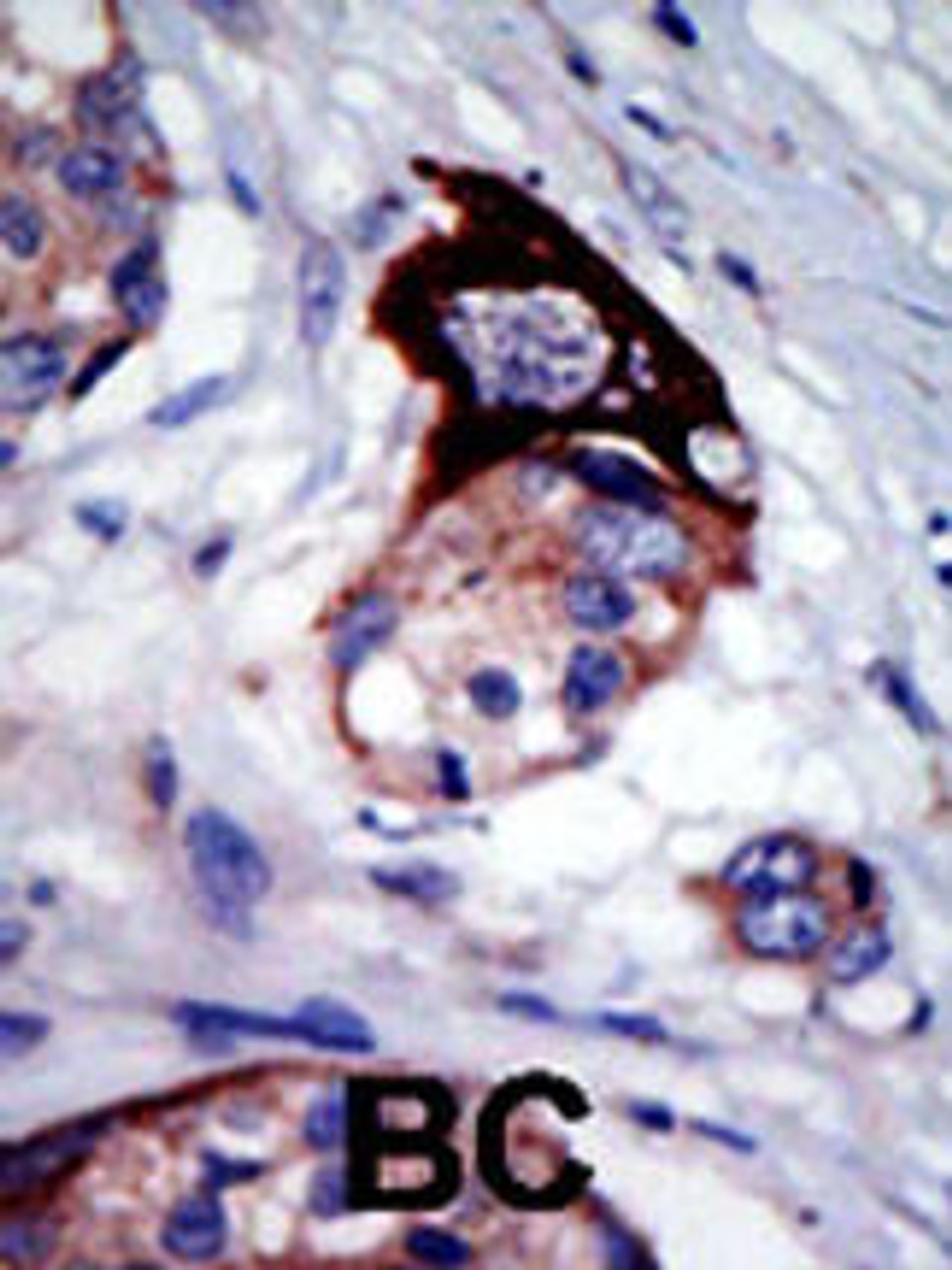 Formalin-fixed and paraffin-embedded human cancer tissue reacted with the primary antibody, which was peroxidase-conjugated to the secondary antibody, followed by AEC staining. BC = breast carcinoma; HC = hepatocarcinoma.