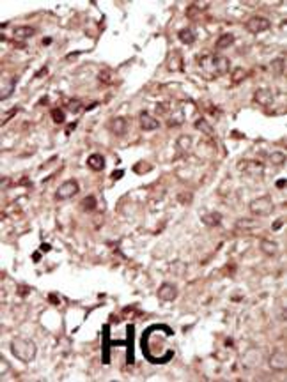 Formalin-fixed and paraffin-embedded human cancer tissue reacted with the primary antibody, which was peroxidase-conjugated to the secondary antibody, followed by AEC staining. BC = breast carcinoma; HC = hepatocarcinoma.